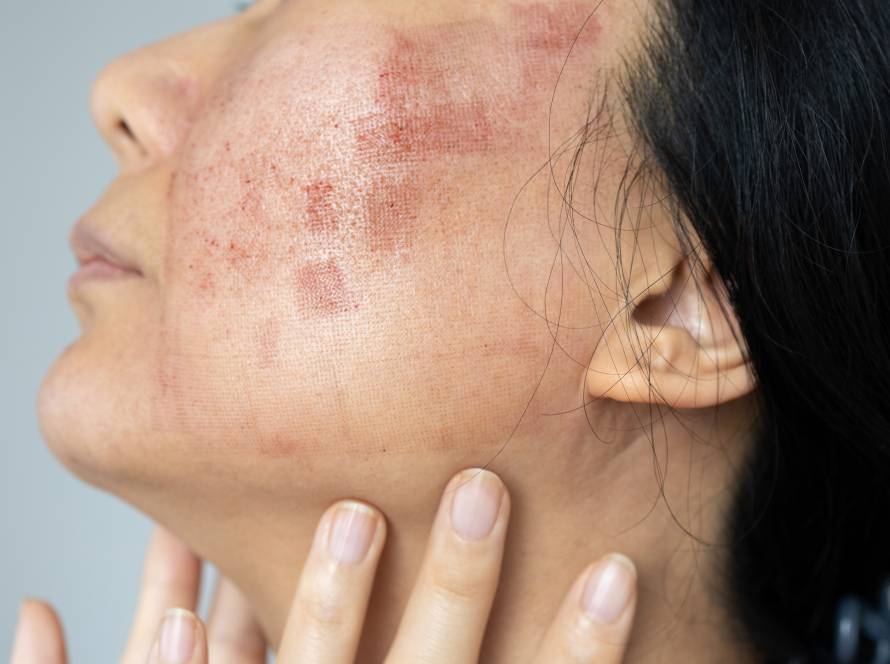 Remoção de Manchas e Melasma