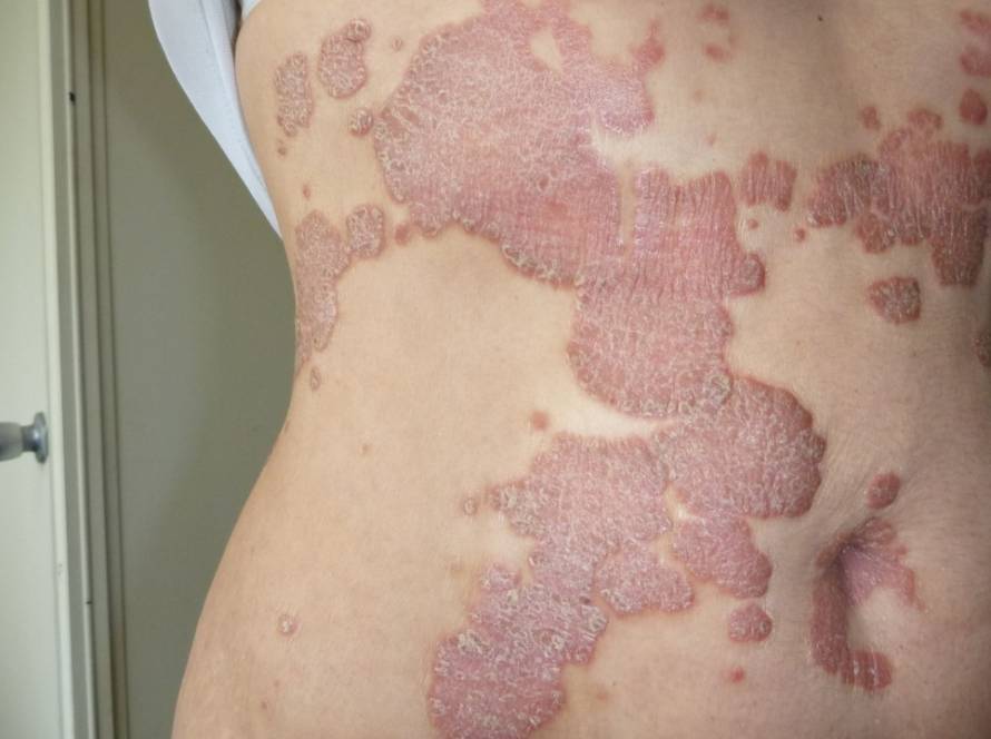 Integrative dermatology psoriasis