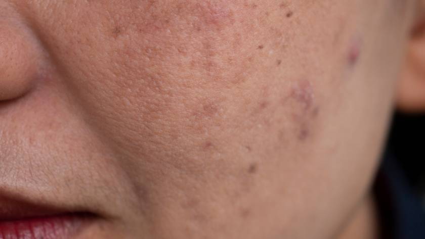 melasma 2