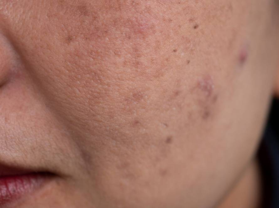 melasma 2