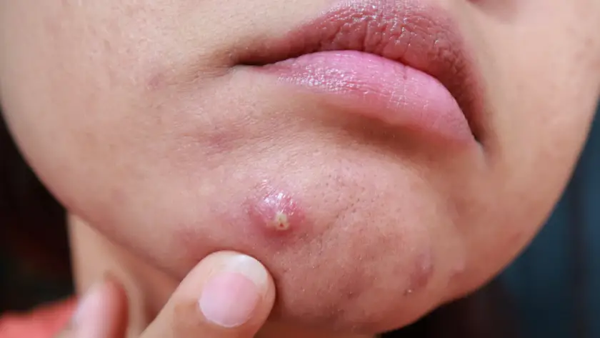 slow healing of acne