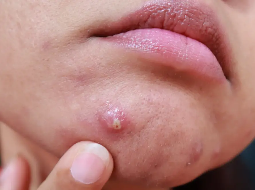 slow healing of acne