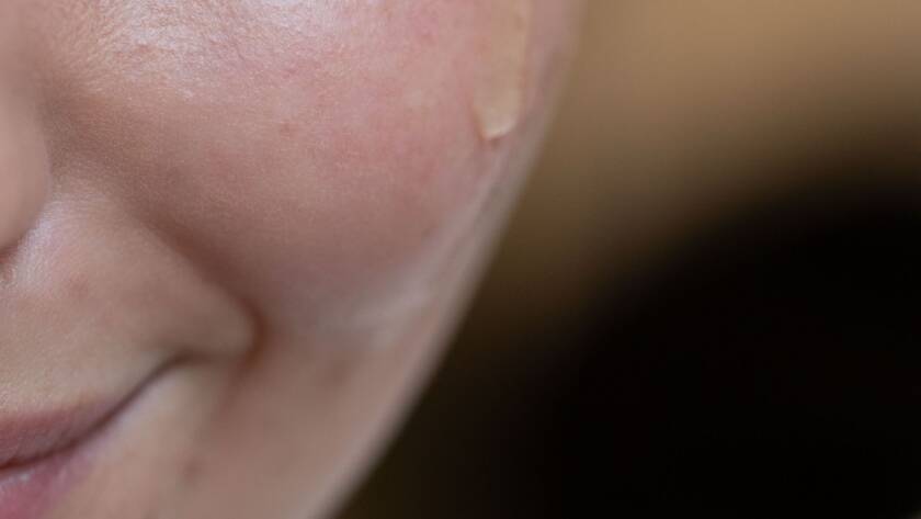 Aplicação de sérum facial em tratamento de acne na dermatologia integrativa em BH