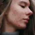 Acne adulta feminina: causas hormonais e tratamento dermatológico em BH