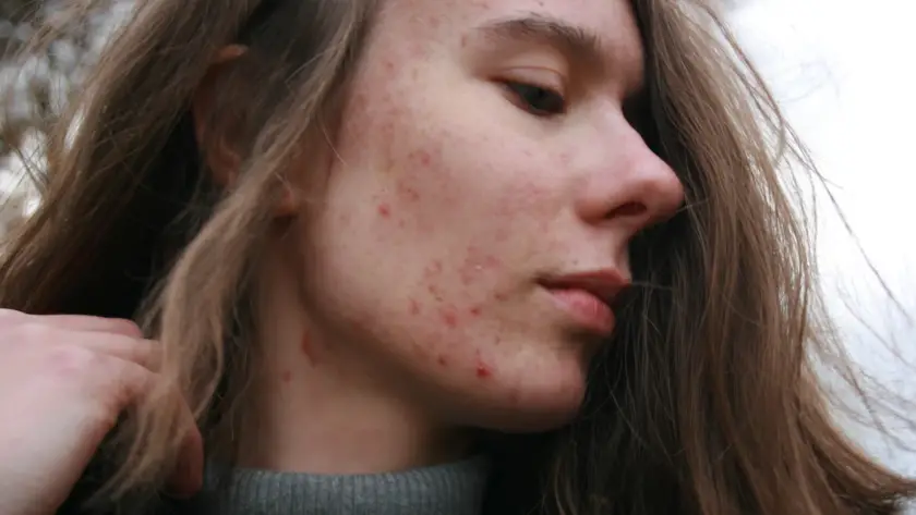 Rosto de mulher adulta com acne, condição tratada por dermatologista em BH