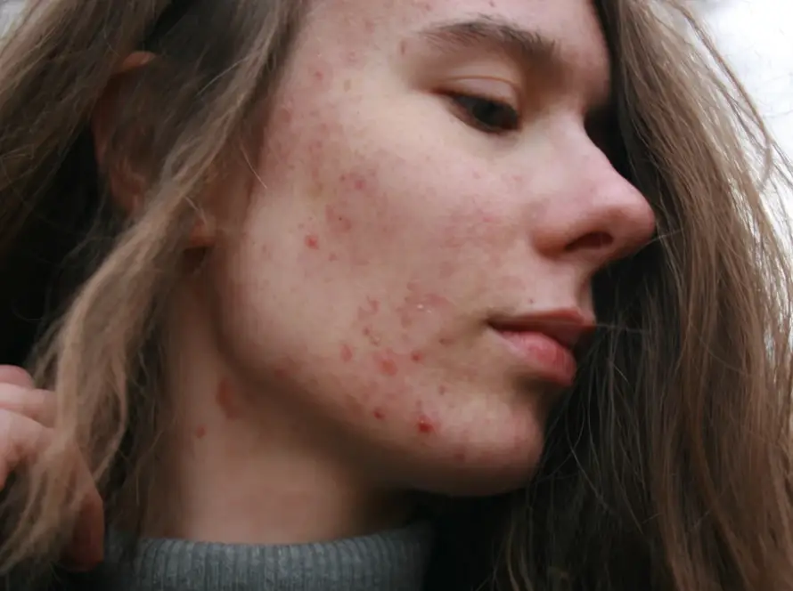 Rosto de mulher adulta com acne, condição tratada por dermatologista em BH