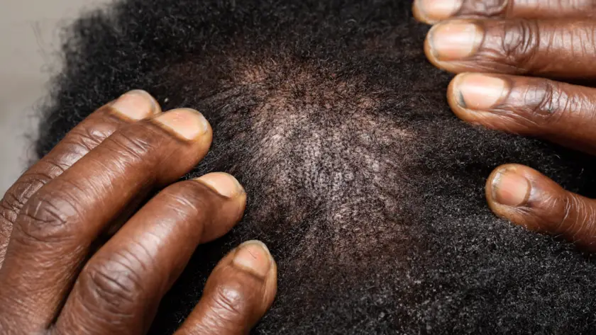 Dermatologista examinando o couro cabeludo de paciente com alopecia androgenética