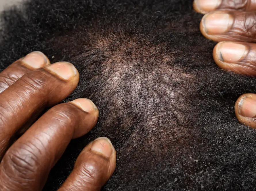 Dermatologista examinando o couro cabeludo de paciente com alopecia androgenética