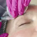 Botox antes e depois: como analisar fotos com segurança antes de fazer