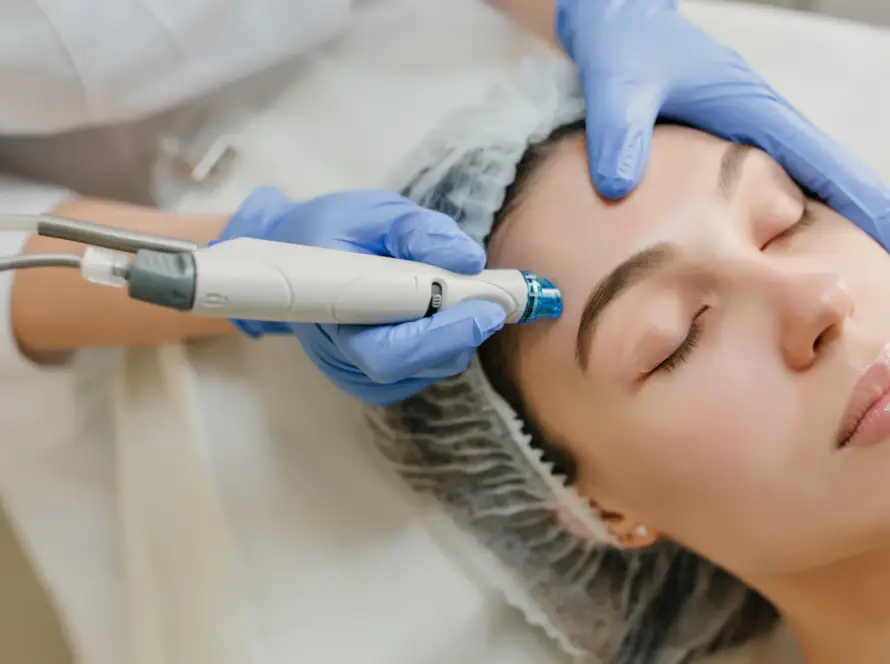 Paciente recebendo sessão de microagulhamento facial em clínica dermatológica