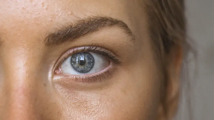 Close dos olhos de uma mulher mostrando a região das olheiras antes do preenchimento