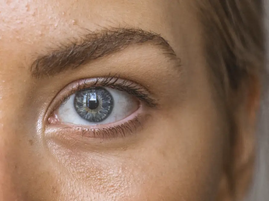 Close dos olhos de uma mulher mostrando a região das olheiras antes do preenchimento